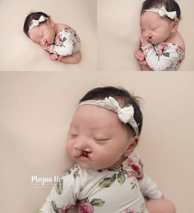 sleeping newborn girl in bedford nh studio session in flower outfit with cleft lip